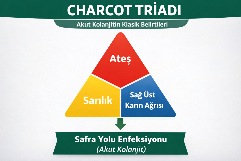 Charcot triadı diyagramı: akut kolanjitte ateş, sarılık ve sağ üst karın ağrısını gösteren üçgen şema