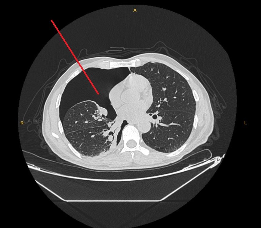 Siyah alanı gösteren kırmızı ok plevral boşluktaki havayı göstermektedir.
