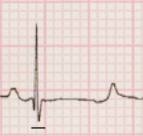 QRS