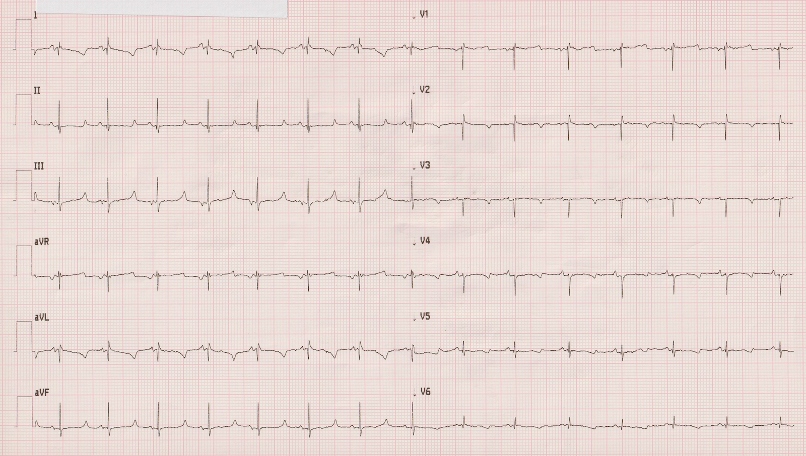 EKG